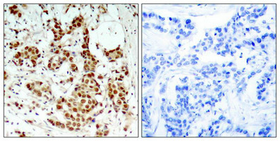 Immunohistochemical analysis of paraffin-embedded human breast carcinoma tissue using p90RSK(Phospho-Thr348) Antibody(left) or the same antibody preincubated with blocking peptide(right).
