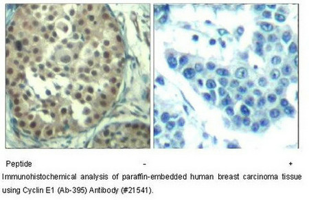Immunohistochemical analysis of paraffin-embedded human breast carcinoma tissueusing Cyclin E1 (Ab-395) Antibody. Immunohistochemical analysis of paraffin-embedded human breast carcinoma tissueusing Cyclin E1 (Ab-395) Antibody.