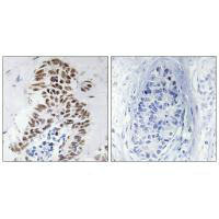 Immunohistochemistry analysis of paraffin-embedded human lung carcinoma tissue using DAPK3 (Ab-265) antibody.