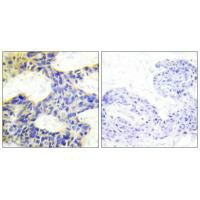 Immunohistochemistry analysis of paraffin-embedded human breast carcinoma tissue using S6K antibody.