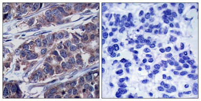 Immunohistochemical analysis of paraffin-embedded human breast carcinoma tissue using p62Dok(Phospho-Tyr362) Antibody(left) or the same antibody preincubated with blocking peptide(right).