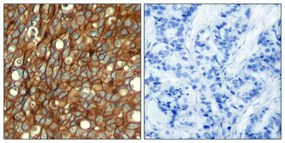 Immunohistochemical analysis of paraffin-embedded human breast carcinoma tissue using HER2 (Phospho-Tyr1248) Antibody (left) or the same antibody preincubated with blocking peptide (right).