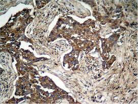 Immunohistochemical analysis of paraffin-embedded human lung carcinoma tissue, using HER2 (Phospho-Tyr1248) Antibody.