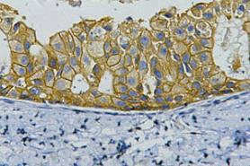 IHC staining of human breast cancer tissue, diluted at 1:200. IHC staining of human breast cancer tissue, diluted at 1:200.