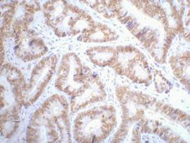 IHC staining of Human colon cancer tissue paraffin-embedded, diluted at 1:200.