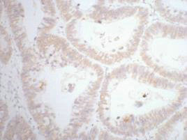 IHC staining of human rectal cancer tissue, diluted at 1:200. IHC staining of human rectal cancer tissue, diluted at 1:200.