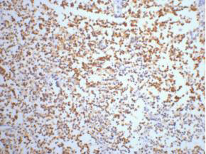 IHC staining of Human small cell carcinoma of lung tissue, diluted at 1:200.