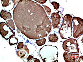 Immunohistochemical analysis of paraffin-embedded Human Thyroid Tissue using TTR Mouse mAb diluted at 1:200.