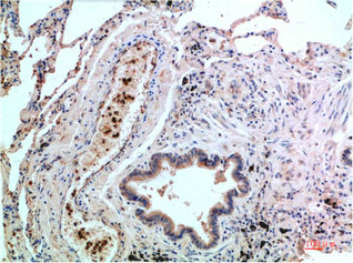 Immunohistochemical analysis of paraffin-embedded Human Lung Carcinoma Tissue using P38 Mouse mAb diluted at 1:200.