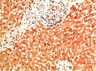 Immunohistochemical analysis of paraffin-embedded Human Liver Carcinoma Tissue using Collagen IV Mouse mAb diluted at 1:200. Immunohistochemical analysis of paraffin-embedded Human Liver Carcinoma Tissue using Collagen IV Mouse mAb diluted at 1:200.