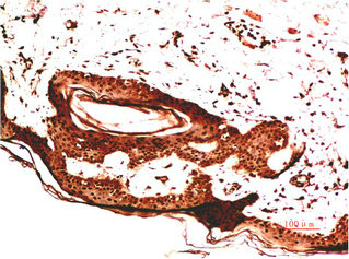 Immunohistochemical analysis of paraffin-embedded Human Liver Carcinoma Tissue using Collagen IV Mouse mAb diluted at 1:2000