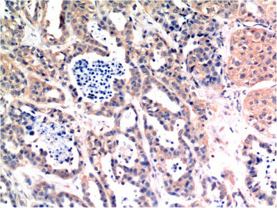 Immunohistochemical analysis of paraffin-embedded Human Breast Carcinoma Tissue using Bax Mouse mAb diluted at 1:200. Immunohistochemical analysis of paraffin-embedded Human Breast Carcinoma Tissue using Bax Mouse mAb diluted at 1:200.
