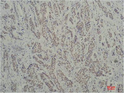 Immunohistochemical analysis of paraffin-embedded Human Breast Carcinoma using TBP/TATA Binding Protein (mAb diluted at 1:200.