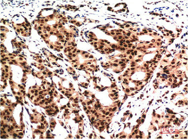 Immunohistochemical analysis of paraffin-embedded Human Breast CarcinomaTissue using Ubiquitin Mouse mAb diluted at 1:200.
