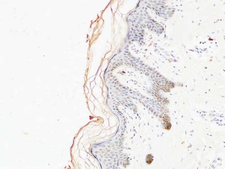 Immunohistochemical analysis of paraffin-embedded Human Colon Carcinoma Tissue using Collagen I Mouse mAb diluted at 1:200. Immunohistochemical analysis of paraffin-embedded Human Colon Carcinoma Tissue using Collagen I Mouse mAb diluted at 1:200.