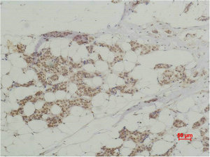 Immunohistochemical analysis of paraffin-embedded human Breast caricnoma using Histone H3 Polyclonal Antibody. Immunohistochemical analysis of paraffin-embedded human Breast caricnoma using Histone H3 Polyclonal Antibody.
