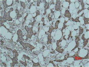 Immunohistochemical analysis of paraffin-embedded human Breast caricnoma using Smad3 Polyclonal Antibody. Immunohistochemical analysis of paraffin-embedded human Breast caricnoma using Smad3 Polyclonal Antibody.