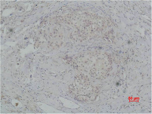 Immunohistochemical analysis of paraffin-embedded human breast caricnoma using PI 3-Kinase p85beta Polyclonal Antibody. Immunohistochemical analysis of paraffin-embedded human breast caricnoma using PI 3-Kinase p85beta Polyclonal Antibody.
