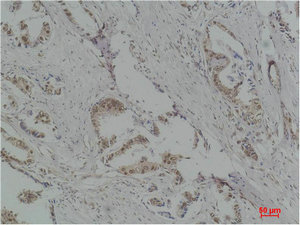 Immunohistochemical analysis of paraffin-embedded Human Breast Carcinoma using p70 S6 kinase alpha Polyclonal Antibody. Immunohistochemical analysis of paraffin-embedded Human Breast Carcinoma using p70 S6 kinase alpha Polyclonal Antibody.