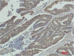 Immunohistochemical analysis of paraffin-embedded Human Colon Carcinoma using MEK-1 Polyclonal Antibody.
