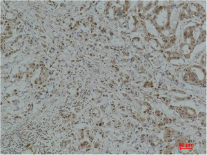 Immunohistochemical analysis of paraffin-embedded Human Breast Carcinoma using GAPDH Polyclonal Antibody. Immunohistochemical analysis of paraffin-embedded Human Breast Carcinoma using GAPDH Polyclonal Antibody.