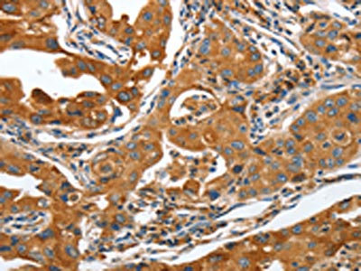 The image on the left is immunohistochemistry of paraffin-embedded Human lung cancer tissue using CSB-PA005512(ANAPC10 Antibody) at dilution 1/40, on the right is treated with fusion protein. (Original magnification: x200)