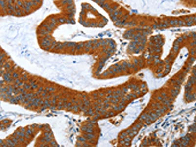 The image on the left is immunohistochemistry of paraffin-embedded Human colon cancer tissue using CSB-PA005512(ANAPC10 Antibody) at dilution 1/40, on the right is treated with fusion protein. (Original magnification: x200) The image on the left is immunohistochemistry of paraffin-embedded Human colon cancer tissue using CSB-PA005512(ANAPC10 Antibody) at dilution 1/40, on the right is treated with fusion protein. (Original magnification: x200)