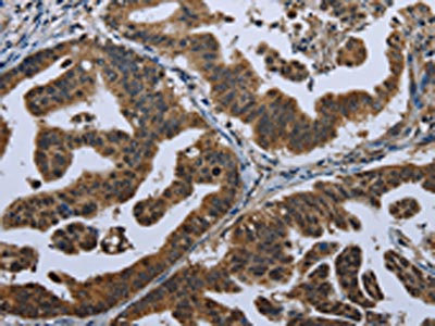 The image on the left is immunohistochemistry of paraffin-embedded Human gastric cancer tissue using CSB-PA010968(GPAM Antibody) at dilution 1/60, on the right is treated with fusion protein. (Original magnification: x200)