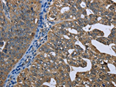 The image on the left is immunohistochemistry of paraffin-embedded Human ovarian cancer tissue using CSB-PA010968(GPAM Antibody) at dilution 1/60, on the right is treated with fusion protein. (Original magnification: x200) The image on the left is immunohistochemistry of paraffin-embedded Human ovarian cancer tissue using CSB-PA010968(GPAM Antibody) at dilution 1/60, on the right is treated with fusion protein. (Original magnification: x200)