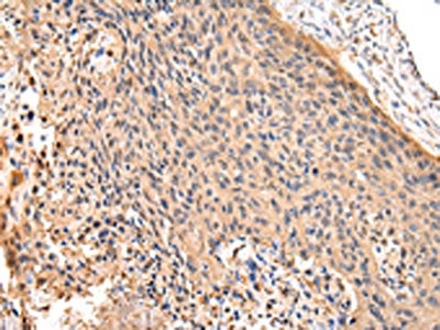 The image on the left is immunohistochemistry of paraffin-embedded Human esophagus cancer tissue using CSB-PA011436(RERE Antibody) at dilution 1/25, on the right is treated with synthetic peptide. (Original magnification: x200)
