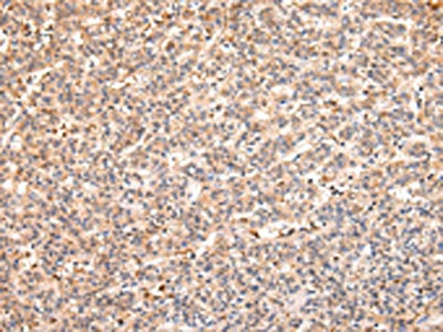 The image on the left is immunohistochemistry of paraffin-embedded Human liver cancer tissue using CSB-PA011436(RERE Antibody) at dilution 1/25, on the right is treated with synthetic peptide. (Original magnification: x200) The image on the left is immunohistochemistry of paraffin-embedded Human liver cancer tissue using CSB-PA011436(RERE Antibody) at dilution 1/25, on the right is treated with synthetic peptide. (Original magnification: x200)