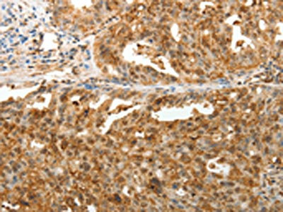 The image on the left is immunohistochemistry of paraffin-embedded Human ovarian cancer tissue using CSB-PA012753(TENM3 Antibody) at dilution 1/50, on the right is treated with synthetic peptide. (Original magnification: x200)