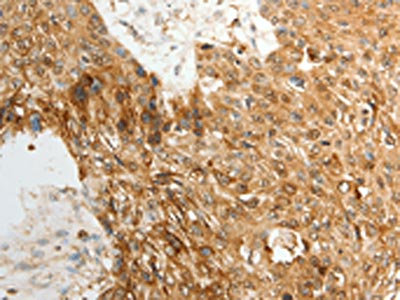 The image on the left is immunohistochemistry of paraffin-embedded Human esophagus cancer tissue using CSB-PA012753(TENM3 Antibody) at dilution 1/50, on the right is treated with synthetic peptide. (Original magnification: x200)