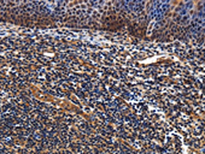 The image on the left is immunohistochemistry of paraffin-embedded Human tonsil tissue using CSB-PA014309(LRRC57 Antibody) at dilution 1/40, on the right is treated with fusion protein. (Original magnification: x200)