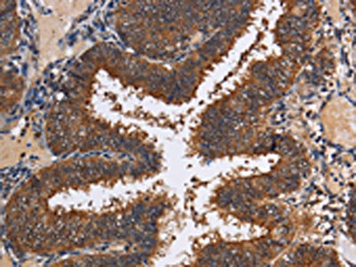 The image on the left is immunohistochemistry of paraffin-embedded Human colon cancer tissue using CSB-PA014309(LRRC57 Antibody) at dilution 1/40, on the right is treated with fusion protein. (Original magnification: x200)
