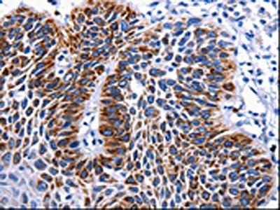 The image is immunohistochemistry of paraffin-embedded Human liver cancer tissue using CSB-PA016457(RAB25 Antibody) at dilution 1/50. (Original magnification: 200)