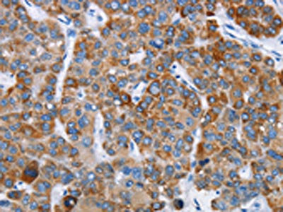 The image on the left is immunohistochemistry of paraffin-embedded Human liver cancer tissue using CSB-PA017354(CHDH Antibody) at dilution 1/20, on the right is treated with fusion protein. (Original magnification: x200) The image on the left is immunohistochemistry of paraffin-embedded Human liver cancer tissue using CSB-PA017354(CHDH Antibody) at dilution 1/20, on the right is treated with fusion protein. (Original magnification: x200)