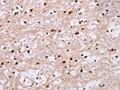 The image on the left is immunohistochemistry of paraffin-embedded Human brain tissue using CSB-PA018458(NUP50 Antibody) at dilution 1/30, on the right is treated with fusion protein. (Original magnification: x200)