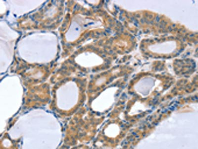 The image on the left is immunohistochemistry of paraffin-embedded Human thyroid cancer tissue using CSB-PA020995(SNX4 Antibody) at dilution 1/25, on the right is treated with fusion protein. (Original magnification: x200) The image on the left is immunohistochemistry of paraffin-embedded Human thyroid cancer tissue using CSB-PA020995(SNX4 Antibody) at dilution 1/25, on the right is treated with fusion protein. (Original magnification: x200)