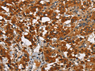 The image on the left is immunohistochemistry of paraffin-embedded Human thyroid cancer tissue using CSB-PA022161(SMAD9 Antibody) at dilution 1/40, on the right is treated with synthetic peptide. (Original magnification: x200) The image on the left is immunohistochemistry of paraffin-embedded Human thyroid cancer tissue using CSB-PA022161(SMAD9 Antibody) at dilution 1/40, on the right is treated with synthetic peptide. (Original magnification: x200)