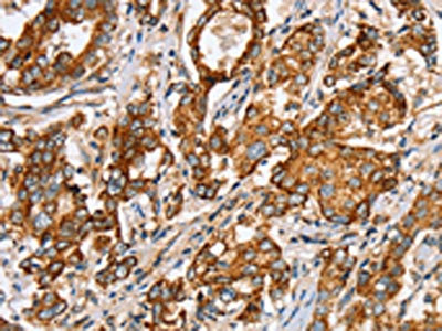 The image on the left is immunohistochemistry of paraffin-embedded Human liver cancer tissue using CSB-PA022560(SLC5A11 Antibody) at dilution 1/35, on the right is treated with synthetic peptide. (Original magnification: x200) The image on the left is immunohistochemistry of paraffin-embedded Human liver cancer tissue using CSB-PA022560(SLC5A11 Antibody) at dilution 1/35, on the right is treated with synthetic peptide. (Original magnification: x200)