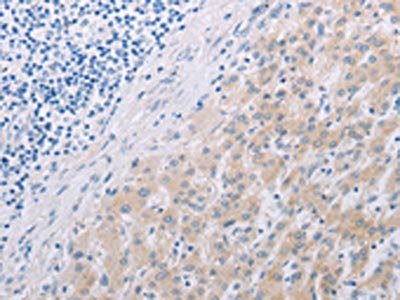 The image on the left is immunohistochemistry of paraffin-embedded Human liver cancer tissue using CSB-PA023267(PFN2 Antibody) at dilution 1/30, on the right is treated with synthetic peptide. (Original magnification: x200)