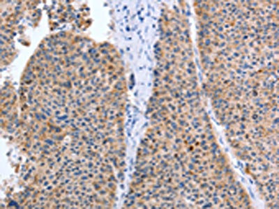The image on the left is immunohistochemistry of paraffin-embedded Human liver cancer tissue using CSB-PA024203(TAT Antibody) at dilution 1/35, on the right is treated with fusion protein. (Original magnification: x200)