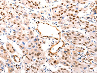 The image on the left is immunohistochemistry of paraffin-embedded Human lung cancer tissue using CSB-PA024373(CASP9 (active) Antibody) at dilution 1/80, on the right is treated with synthetic peptide. (Original magnification: x200)