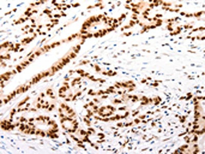 The image on the left is immunohistochemistry of paraffin-embedded Human colon cancer tissue using CSB-PA024373(CASP9 (active) Antibody) at dilution 1/80, on the right is treated with synthetic peptide. (Original magnification: x200) The image on the left is immunohistochemistry of paraffin-embedded Human colon cancer tissue using CSB-PA024373(CASP9 (active) Antibody) at dilution 1/80, on the right is treated with synthetic peptide. (Original magnification: x200)