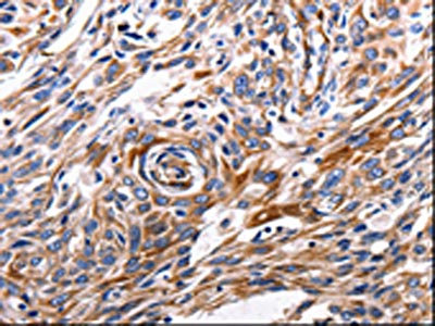 The image is immunohistochemistry of paraffin-embedded Human esophagus cancer tissue using CSB-PA025395(ACE2 Antibody) at dilution 1/200. (Original magnification: x200)