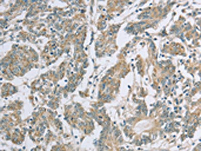 The image on the left is immunohistochemistry of paraffin-embedded Human colon cancer tissue using CSB-PA025575(EDA2R Antibody) at dilution 1/50, on the right is treated with fusion protein. (Original magnification: x200)