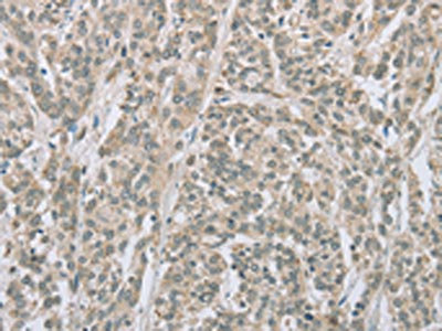 The image on the left is immunohistochemistry of paraffin-embedded Human esophagus cancer tissue using CSB-PA025575(EDA2R Antibody) at dilution 1/50, on the right is treated with fusion protein. (Original magnification: x200) The image on the left is immunohistochemistry of paraffin-embedded Human esophagus cancer tissue using CSB-PA025575(EDA2R Antibody) at dilution 1/50, on the right is treated with fusion protein. (Original magnification: x200)
