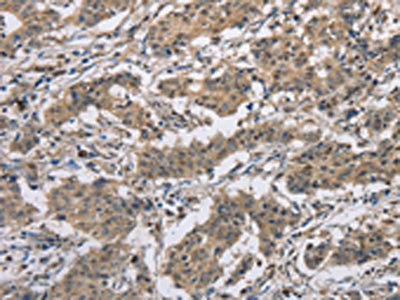 The image on the left is immunohistochemistry of paraffin-embedded Human gastric cancer tissue using CSB-PA025645(DSG2 Antibody) at dilution 1/50, on the right is treated with fusion protein. (Original magnification: x200)
