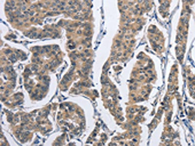 The image on the left is immunohistochemistry of paraffin-embedded Human breast cancer tissue using CSB-PA025645(DSG2 Antibody) at dilution 1/50, on the right is treated with fusion protein. (Original magnification: x200) The image on the left is immunohistochemistry of paraffin-embedded Human breast cancer tissue using CSB-PA025645(DSG2 Antibody) at dilution 1/50, on the right is treated with fusion protein. (Original magnification: x200)